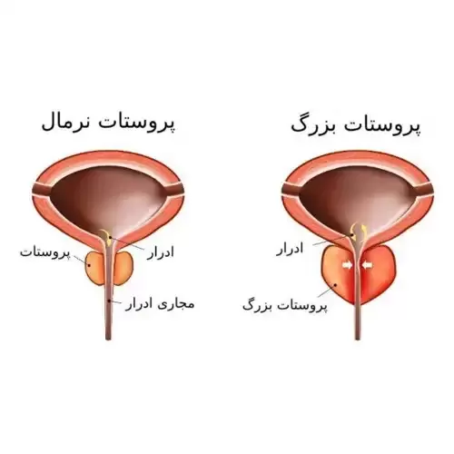 سرطان پروستات پیشرفته